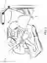 Fig. 02 - Robotically assisted bone preparation for positioning of cutting block