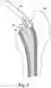 Fig. 07 - Orthopaedic broach extraction tool