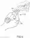 Fig. 06 - VERTEBRAL JOINT IMPLANTS AND DELIVERY TOOLS