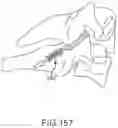 Fig. 130 - VERTEBRAL JOINT IMPLANTS AND DELIVERY TOOLS