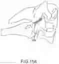 Fig. 131 - VERTEBRAL JOINT IMPLANTS AND DELIVERY TOOLS