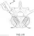 Fig. 142 - VERTEBRAL JOINT IMPLANTS AND DELIVERY TOOLS