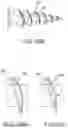 Fig. 30 - VERTEBRAL JOINT IMPLANTS AND DELIVERY TOOLS