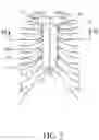 Fig. 03 - STERNUM FIXATION DEVICE AND METHOD