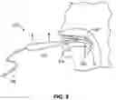 Fig. 10 - SOFT PALATE TREATMENT