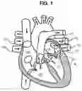 Fig. 02 - HEART VALVE IMPLANT