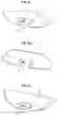 Fig. 06 - HEART VALVE IMPLANT