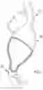 Fig. 02 - FUSIFORM ANEURYSM TREATMENT