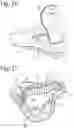 Fig. 09 - STRENGTH-REINFORCED SINGLE USE BEDPAN