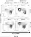 Fig. 22 - AUTOLOGOUS THYMIC TISSUE TRANSPLANTATION