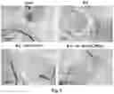 Fig. 10 - Composition and Use of Interleukin Stimulated Human Umbilical Cord Mesenchymal Stem Cells for the Treatment of Rheumatoid Arthritis