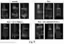 Fig. 11 - Composition and Use of Interleukin Stimulated Human Umbilical Cord Mesenchymal Stem Cells for the Treatment of Rheumatoid Arthritis