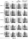 Fig. 12 - Composition and Use of Interleukin Stimulated Human Umbilical Cord Mesenchymal Stem Cells for the Treatment of Rheumatoid Arthritis