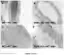 Fig. 03 - COMPOSITIONS AND METHODS FOR GRAFTS MODIFIED WITH A NON-THROMBOGENIC AND PRO-MIGRATORY CELL-DERIVED EXTRACELLULAR MATRIX