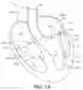 Fig. 02 - Diagnostic catheters, guide catheters, visualization devices and chord manipulation devices, and related kits and methods