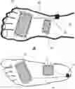 Fig. 01 - Peripheral neuromodulation to treat bladder and bowel dysfunction