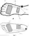Fig. 03 - Peripheral neuromodulation to treat bladder and bowel dysfunction