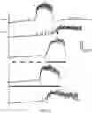 Fig. 27 - Peripheral neuromodulation to treat bladder and bowel dysfunction