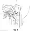 Fig. 02 - Position sensitive lingual muscle stimulation system for obstructive sleep apnea
