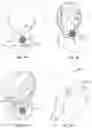 Fig. 05 - Apparatuses and methods for transdermal electrical stimulation of nerves to modify or induce a cognitive state