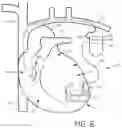 Fig. 04 - System and method for increasing left ventricular torsion by multi-point pacing