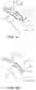 Fig. 06 - Emergency leak clamp