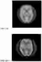 Fig. 06 - Weighting detector configurations in SPECT imaging