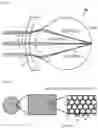Fig. 07 - OPHTHALMOLOGICAL LENS