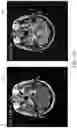 Fig. 06 - METHOD FOR ENHANCING AN ACCURACY OF A BENIGN TUMOR DEVELOPMENT TREND ASSESSMENT SYSTEM