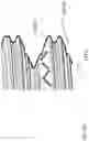 Fig. 32 - BONE CONDUCTION IMPLANT