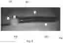 Fig. 11 - ENDOSCOPIC DEVICE WITH ADDITIONAL CHANNEL