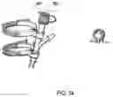 Fig. 56 - ENDOSCOPIC DEVICE WITH ADDITIONAL CHANNEL