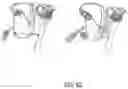Fig. 65 - ENDOSCOPIC DEVICE WITH ADDITIONAL CHANNEL