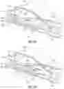 Fig. 05 - Endoluminal device with retractor system