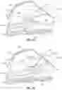 Fig. 06 - Endoluminal device with retractor system