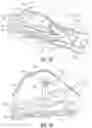 Fig. 07 - Endoluminal device with retractor system
