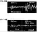 Fig. 15 - Device and method for in vivo flow cytometry using the detection of photoacoustic waves
