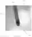 Fig. 15 - DEVICES, SYSTEMS AND METHODS FOR TISSUE ANALYSIS, LOCATON DETERMINATION AND TISSUE ABLATION