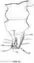 Fig. 80 - ANTENNAS FOR A SUBCUTANEOUS DEVICE