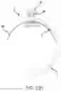 Fig. 30 - Vascular closure device