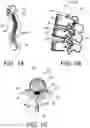 Fig. 02 - Devices and methods for spinal decompression surgery