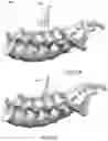 Fig. 10 - Devices and methods for spinal decompression surgery