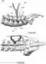 Fig. 11 - Devices and methods for spinal decompression surgery