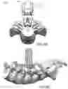 Fig. 13 - Devices and methods for spinal decompression surgery