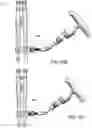 Fig. 15 - Devices and methods for spinal decompression surgery