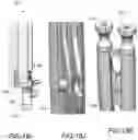 Fig. 25 - Devices and methods for spinal decompression surgery