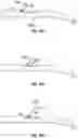 Fig. 17 - METHODS AND DEVICES FOR BIDIRECTIONAL CROSSING OF AN OBSTRUCTION
