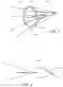 Fig. 05 - Method for treating vascular occlusion