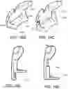 Fig. 17 - Device and method for treating nosebleeds