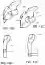Fig. 20 - Device and method for treating nosebleeds